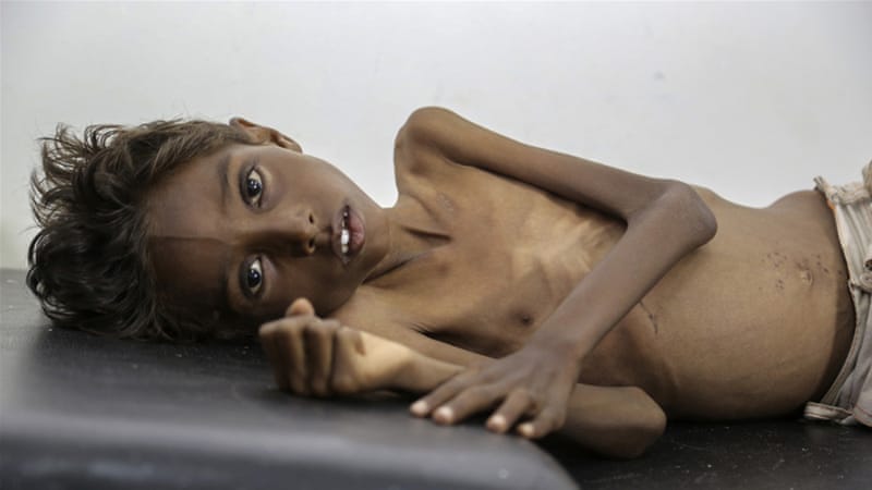 Image result for starving in yemen