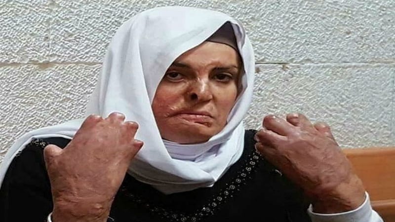 Israa Jaabis, sentenced to 11 years, suffers from burns all over her body and is not being treated adequately inside an Israeli prison [Wadi Hilweh Information Center]