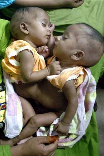 BANGLADESH-HEALTH-CHILD-TWINS