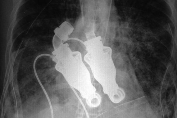 Artificial, heart, organ, x ray, scan.