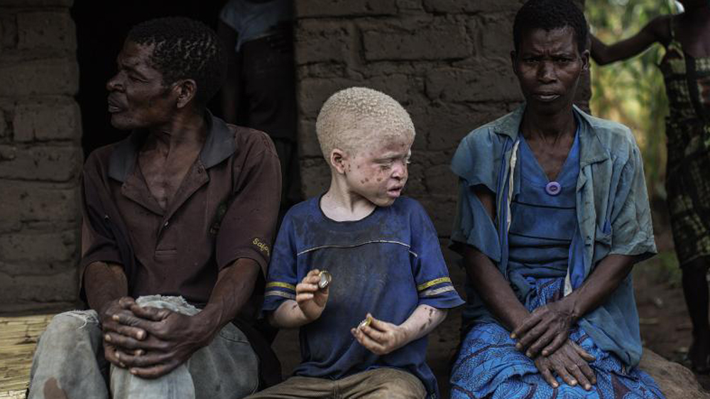 Attacks against people with albinism this year have also been reported in Burundi, Mozambique and Zambia [Gallo/Getty] 