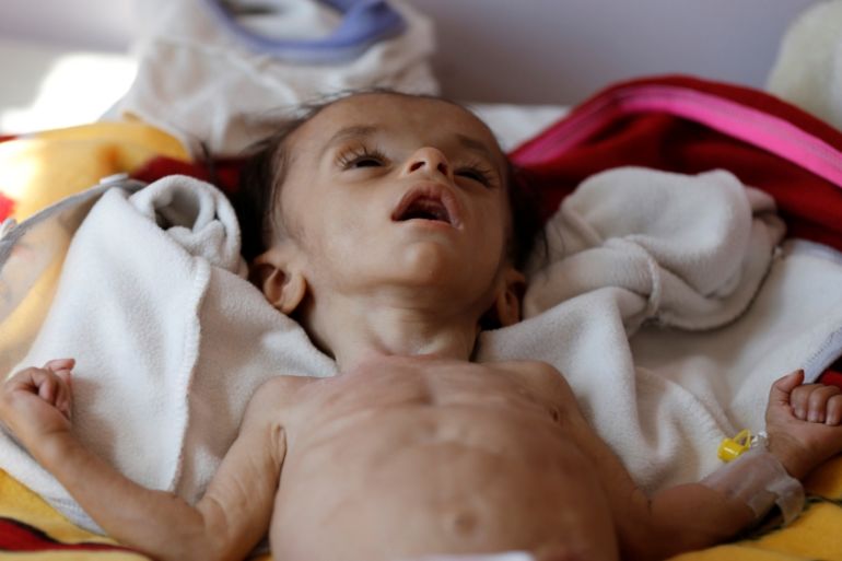 DO NOT USE - Malnourished Yemeni child