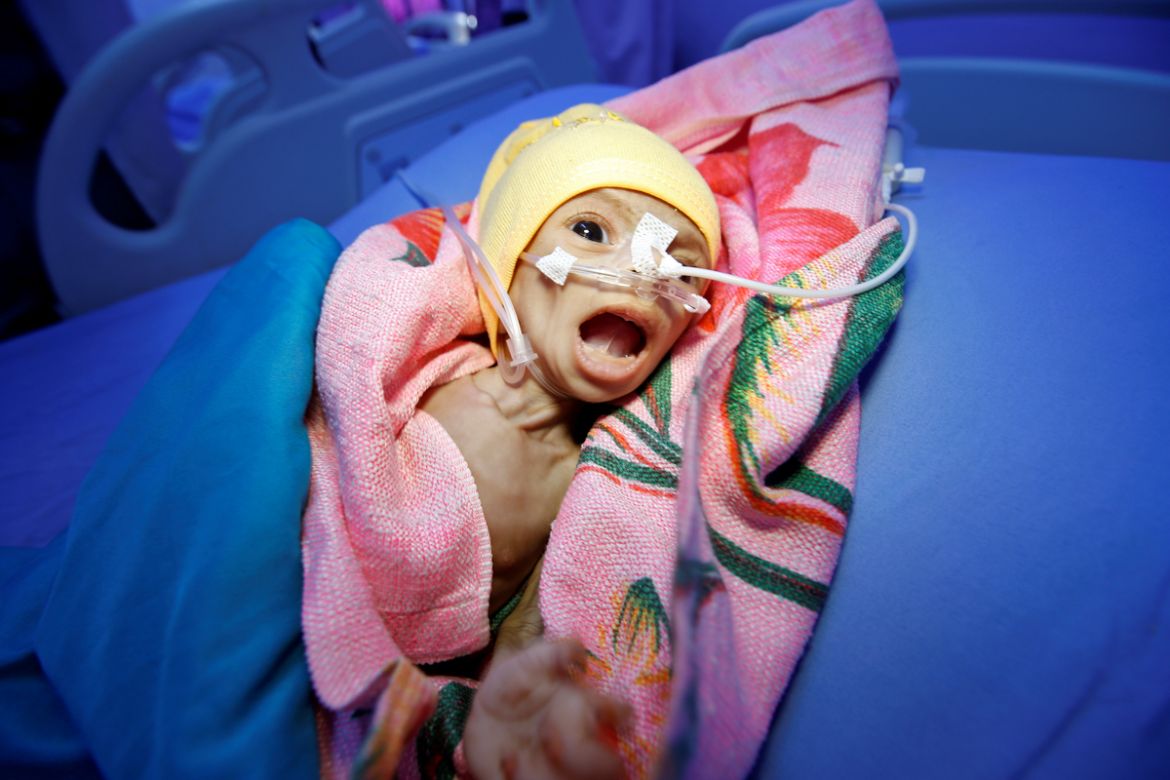 Sixty-day-old Nadia Ahmad Sabri, who suffers from severe malnutrition, lies in bed at a malnutrition treatment center in the Red Sea port city of Hodeida, Yemen December 20, 2017. REUTERS/Abduljabbar