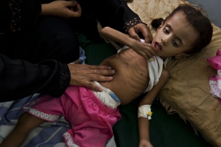 Yemen malnourished child