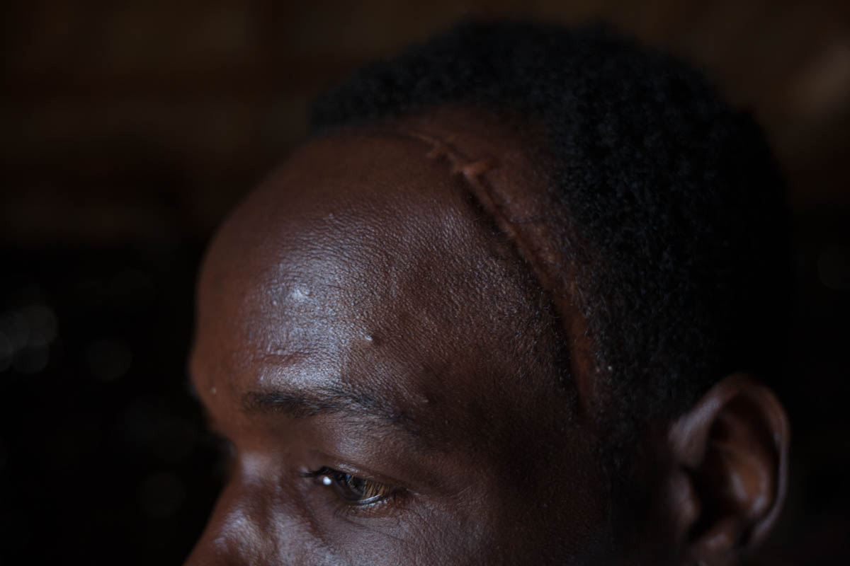 Emmanuel Ngadougou, a 38-year-old father of four, took refuge at the Catholic church in early May. An artisanal diamond miner who worked near Alindao, he says his family was attacked by Seleka fighters in May, leaving three of his family members dead and his house burned to the ground. He suffered a machete wound to the head and was left for dead in a pool of blood. 'I remember it so well and I'm always scared,' he said, noting he also remembers a time when people 'lived in perfect harmony'. [Adrienne Surprenant/Al Jazeera]