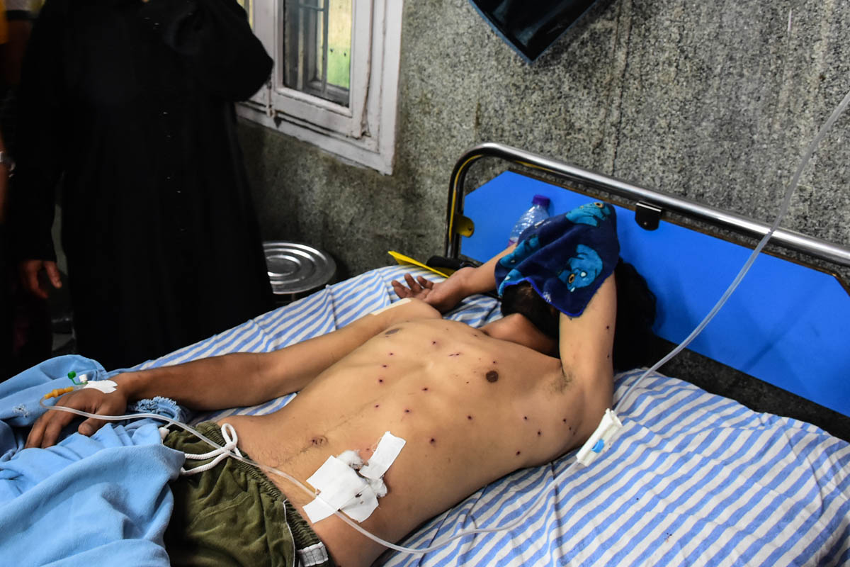 There has been an unprecedented use of pellet guns by the Indian forces to curb protests in the Kashmir valley. Pellets fired upon unarmed protesters cause severe injuries and even blindness. Scores of people, including young boys and children, have been injured since August 5. [Mukhtar Zahoor/Al Jazeera]