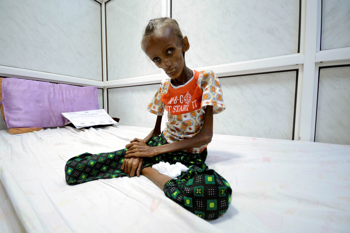 Saida Ahmed Baghili, 18, who had severe malnutrition, sits on a bed at the al-Thawra hospital in the Red Sea port city of Hodeidah, Yemen, October 24, 2016. She became the face of starvation in Yemen's humanitarian crisis with this photo. Reports in following years said she has made steady progress since then. [Abduljabbar Zeyad/Reuters]