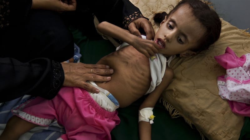 Image result for 370,000 Children in Yemen Were Suffering From Severe Acute Malnutrition as of August 2016 - UNICEF