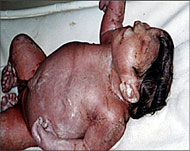 Depleted uranium has caused severe deformities in babies