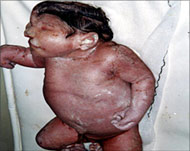 
Depleted uranium has caused severe deformities in babiesDepleted uranium has caused severe deformities in babies