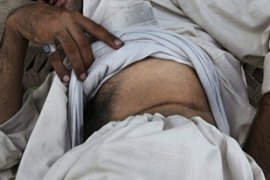 Pakistani shows kidney operation scar