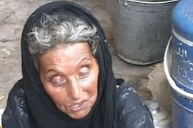 iraq leprosy grab