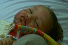Gaza''s war casualties suffering extensive burns - 15 Feb 09- PKG