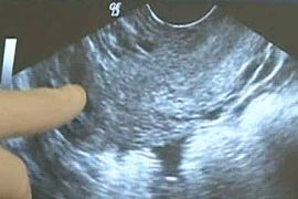 ''No foetal pain'' before 24 weeks, pregnancy scan, baby, abortion
