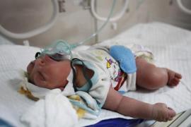An anencephalic child lies in an incubator in a Falluja hospital