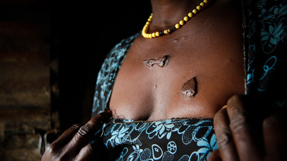 Rose Achayo, former child soldier, pulls down the front of her dress to reveal a series of scars that mark her chest [Marc Ellison]