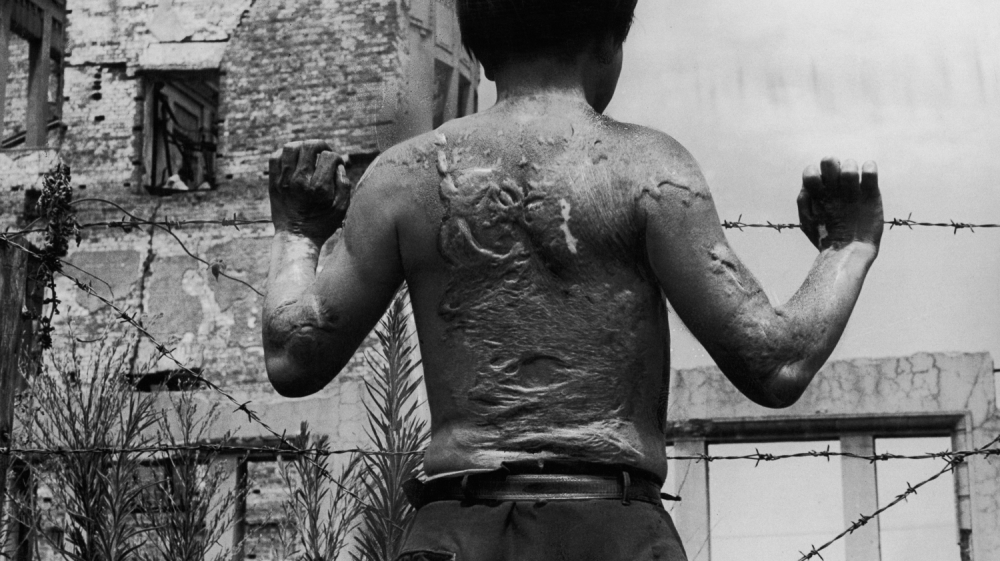 Kiyoshi Yoshikawa, a survivor of the atomic bombing, displays the heavy scarring on his back, soon after leaving hospital [FPG/Hulton Archives/Getty Images]