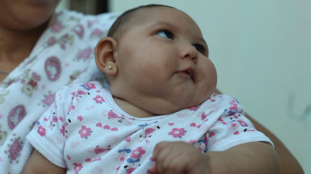 Giovanna is three months old and likely to need full-time care for the rest of her life [Sam Cowie/Al Jazeera] 