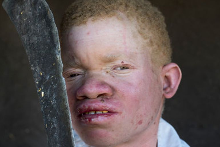 Malawi albinism survivor