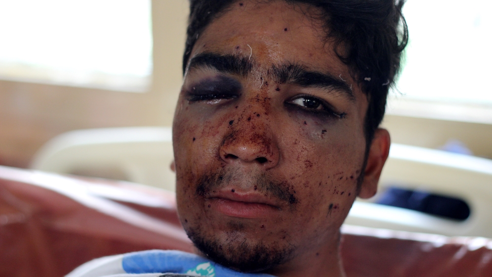 Eighteen-year-old Mehraj doesn't know if he will be able to see out of his right eye again after being shot in the face with a pellet gun [Aarabu Ahmad Sultan/Al Jazeera]
