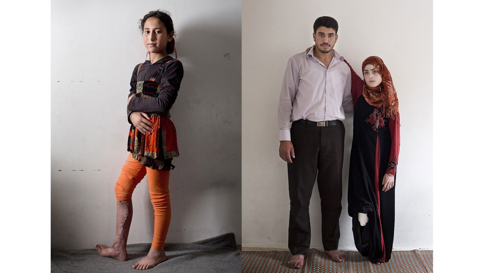 LEFT: Marah, 12, from Zaam in Deraa province, was badly burned coming home from school when flammable substances were detonated remotely. RIGHT: Nagham, 17, from Deraa, and her husband Mohammed al-Hur. She was injured when a rocket hit her home. She was pregnant and lost her child as well as her lower right leg. Her mother died in the blast. [Courtesy of Kai Wiedenhofer]