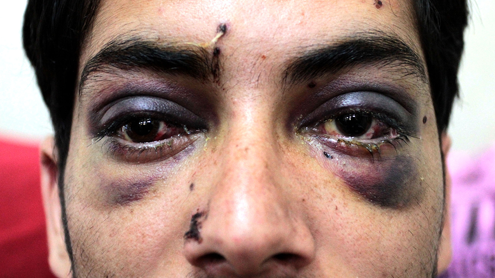  Muhammad Ashraf, 19, from Budgam,  told Al Jazeera that he was walking through paddy fields on September 14 when armed forces fired pellets at him from the highway. He says there were no protests at the time, and he was shocked when he was hit. On the way to the hospital, he says he was stopped at a checkpoint and beaten by police. He says he has taken part in protests and his village has seen many clashes between police and protests [Shuaib Masoodi/Al Jazeera]