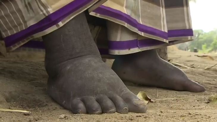 Kenya disease feet al jazeera