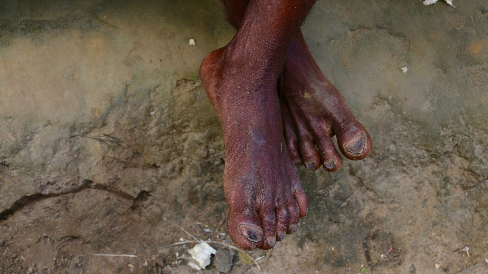 Forty years of vanilla farming show on Men's bare feet. He walks about 10 kilometres every day, spending hours in the fields, unprotected from sticks and insects [Peter Lind/Danwatch]