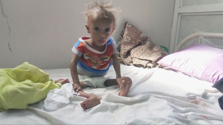 Image of a malnourished child in Yemen