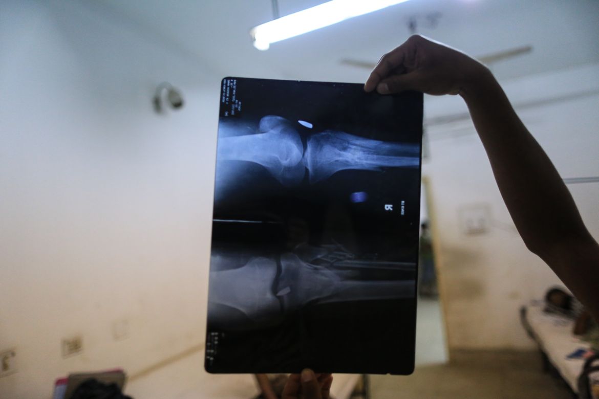 X ray report of Imaan Hussain, 48, shows a bullet embedded in his leg. [Showkat Shafi/Al Jazeera]