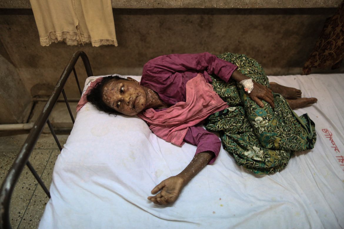 Shahida Begum, 40, lying on the bed in cox’s bar Sadar hospital, she has burn marks all over her body. [Showkat Shafi/Al Jazeera]