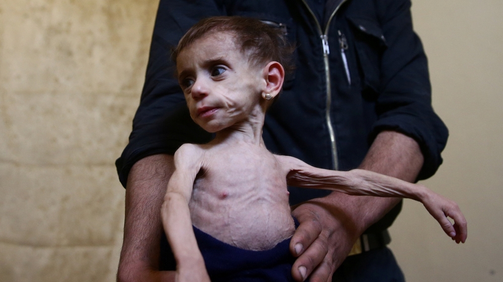 Two-and-a-half year old Hala al-Nufi, who suffers from a metabolic disorder which is worsening due to the siege and food shortages in the eastern Ghouta, is held by her uncle in the eastern Damascus suburb of Ghouta, Syria [Bassam Khabieh/Reuters]