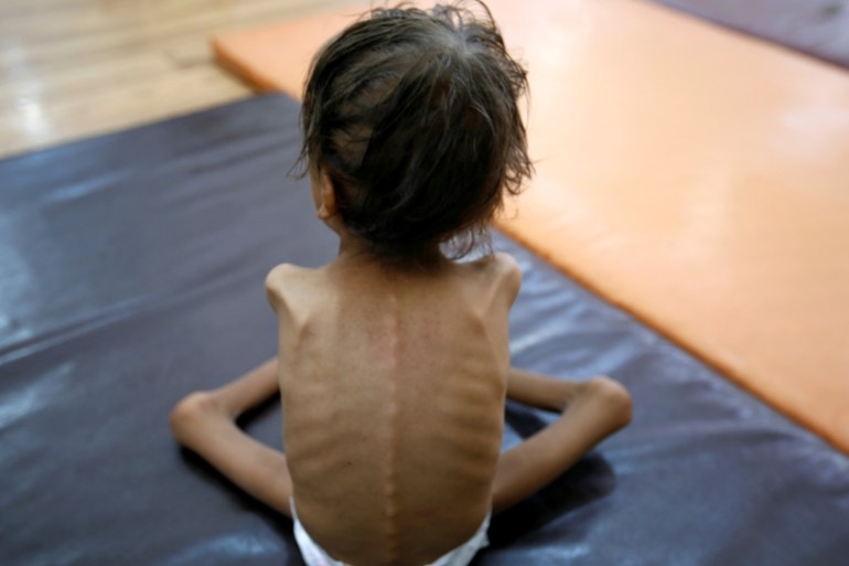 DO NOT USE - A malnourished Yemeni child