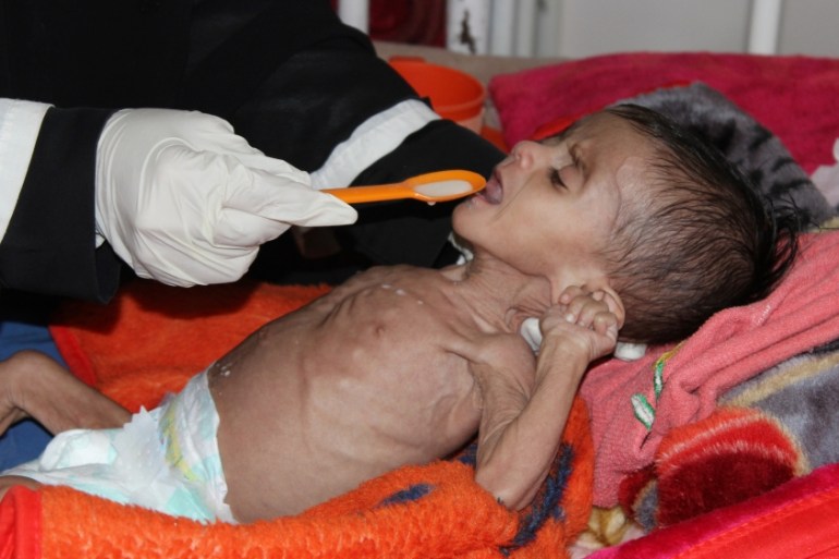 DO NOT USE - Malnourished Yemeni child