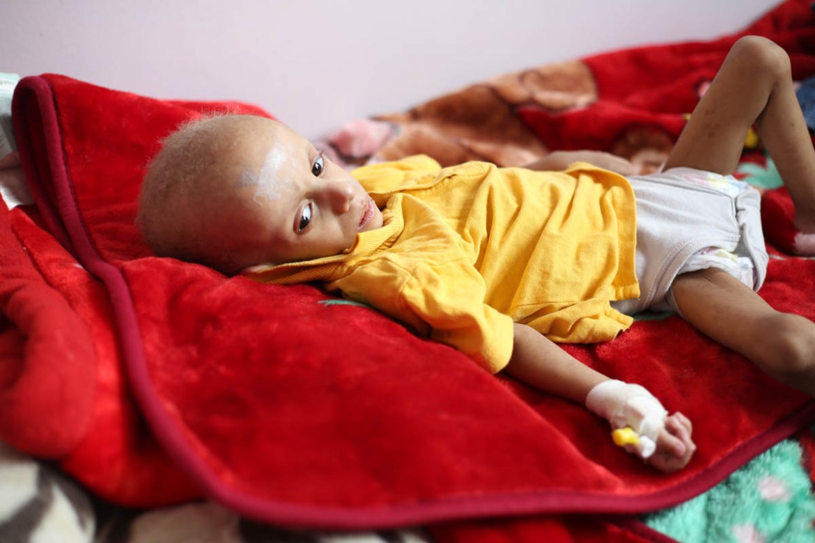 Mohammed’s family travelled by road for close to 15 hours through several checkpoints to reach Al Sabeen Hospital with their malnourished child. “We had no choice, there are no functioning facilitie