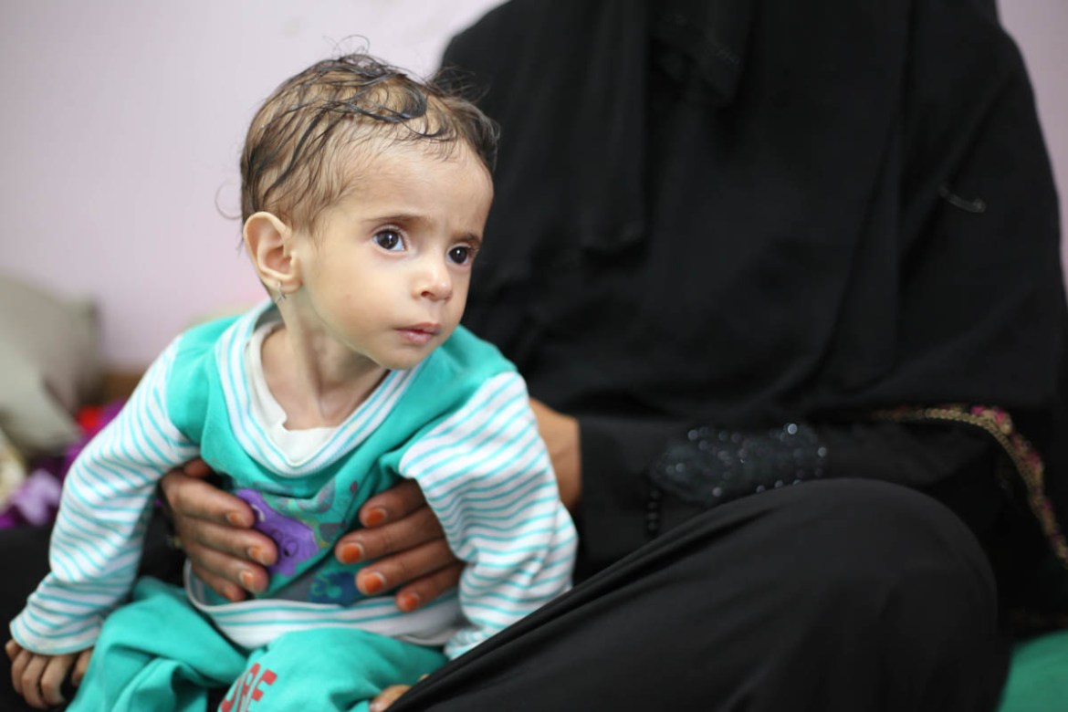One-year-old Fatima weighs 4.2 kgs. She was brought to Al Sabeen Hospital by her mother when she became unwell and developed a fever and has since been receiving care for acute malnutrition. Fatima