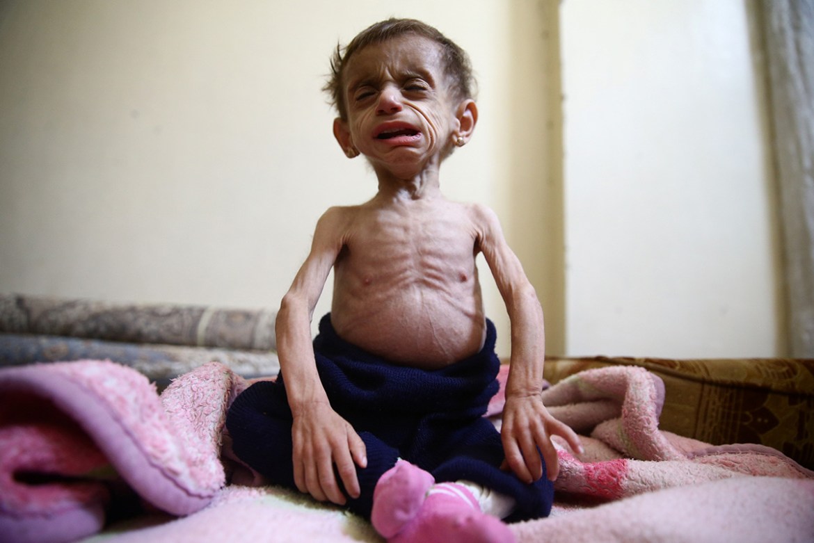 Two-and-a-half year old Hala al-Nufi, who suffers from a metabolic disorder which is worsening due to the siege and food shortages in the eastern Ghouta, reacts as she sits on a bed in the Saqba area,