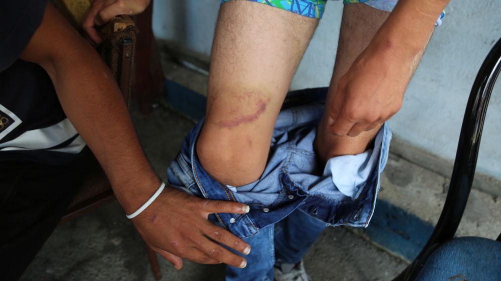 Another refugee shows a large bruise, sustained after an alleged police beating, that has been healing for weeks [Mersiha Gadzo/Al Jazeera]