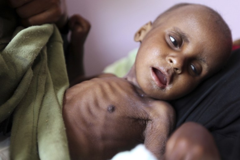 Starving Yemeni child