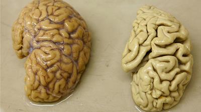 One hemisphere of a healthy brain (L) is pictured next to one hemisphere of a brain of a person suffering from Alzheimer disease  [Denis Balibouse/Reuters]