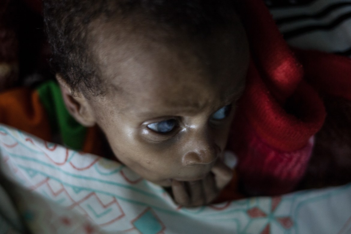 Abdoulaye Moussa, 3 months old, fell ill three days after birth. It started with pimples on his feet, then he lost weight. Her mother, Mariam Moussa, 26, was ill throughout her pregnancy, which she sp