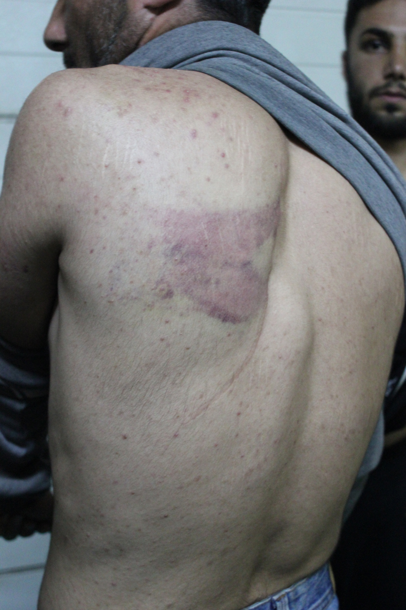 A group of Iranian refugees told Al Jazeera that they had been beaten and accused Croatian police, and showed this reporter their injuries [Katy Fallon/Al Jazeera]