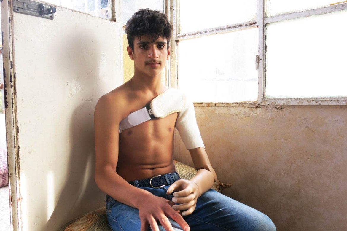 Ahmad is the first patient to receive an above-elbow 3D printed prosthetic from the MSF programme. For this prosthesis, technicians added an extra piece to substitute the humerus. He will be able to b