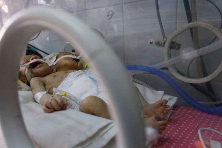 Newly born conjoined twins at the al-Thawra hospital in Sanaa, Yemen