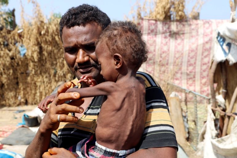 Hanaa Ahmad Ali Bahr, a malnourished girl is seen with her father at a shanty town in Hodeidah