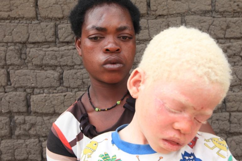 Albinism in Malawi