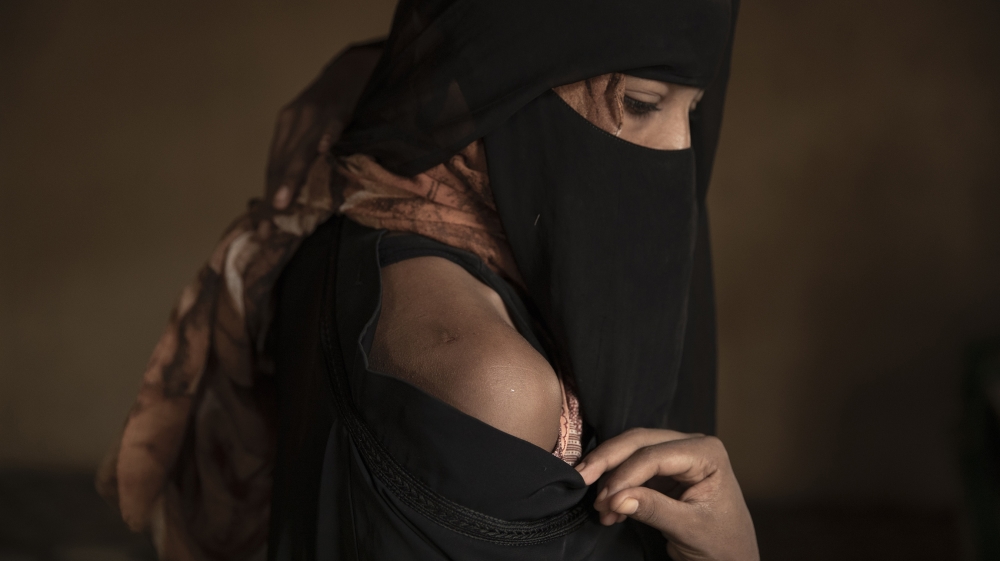 In this July 21, 2019 photo, Ethiopian migrant Eman Idrees shows her shoulder with a wound from torture after being held and abused for eight months in a desert compound known in Arabic as a 