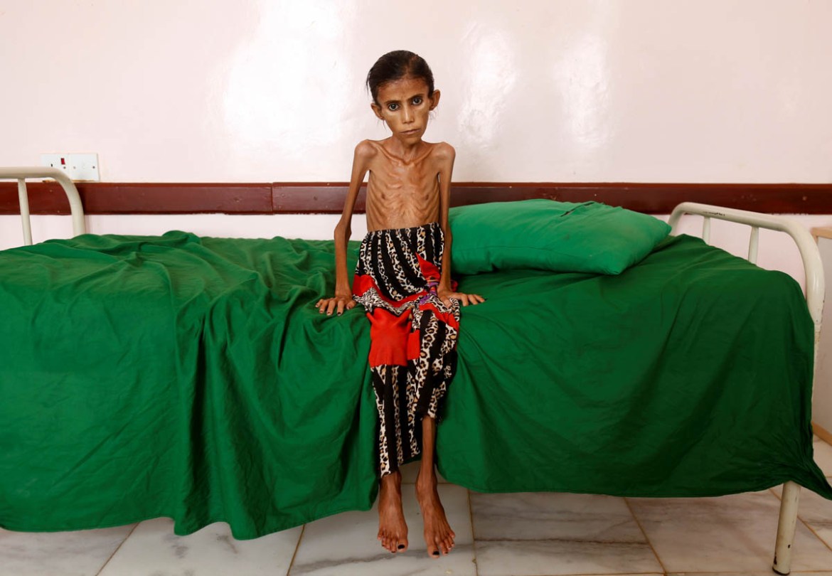 Fatima Ibrahim Hadi, 12, who is malnourished and weighs just 10kg, sits on a bed at a clinic in Aslam, in the northwestern province of Hajjah, Yemen, February 17, 2019. REUTERS/Khaled Abdullah/File Ph