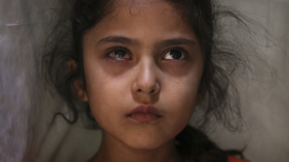 Six-year-old Muneefa Nazir, a Kashmiri girl whose right eye was hit by a marble ball shot allegedly by Indian Paramilitary soldiers on Aug. 12, stands outside her home in Srinagar, Indian controlled K