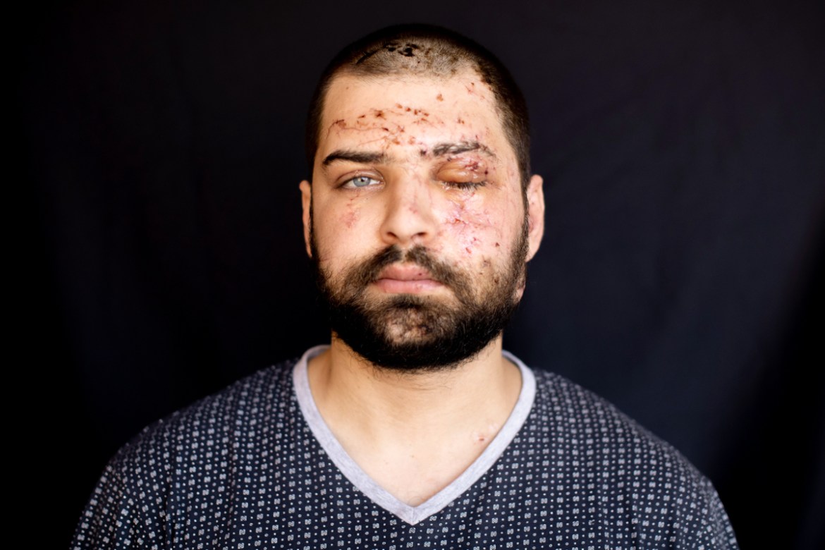 Hassan Nabha, 27, a computer and communication engineer, who got injured at his office during the Aug. 4 explosion that killed more than 170 people, injured thousands and caused widespread destruction